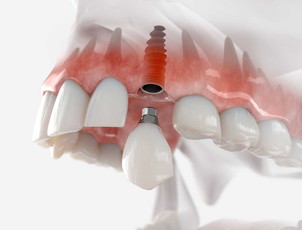 El auge de los implantes dentales